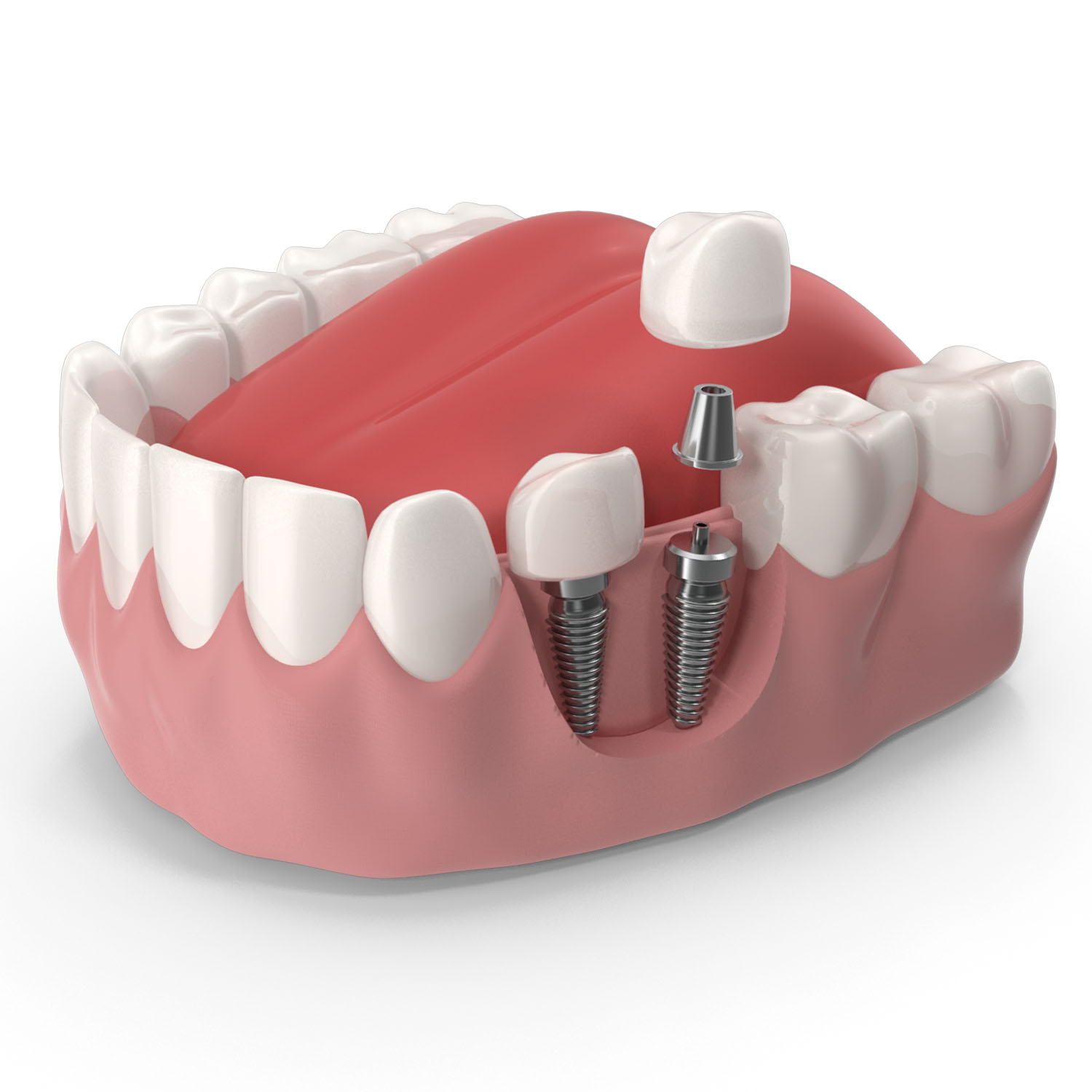 dental implants image